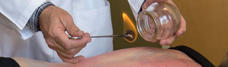 Picture of a acupuncturist demonstrating cupping technique on a patient.